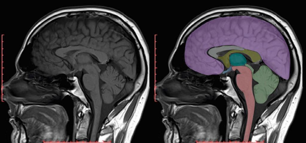 Anatomie des Gehirns 35 Das Gehirn eines der Buchautoren im MRT-Scan.