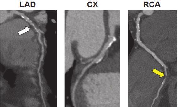 Abbildung 3 Klinisches Beispiel für den Nutzen der SPECT/CTCA-Hybrid-Bildgebung.