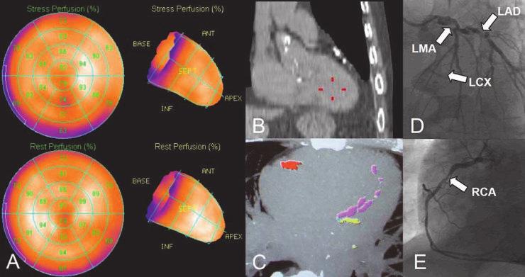 A MP-SPECT polar maps bei einem 52-jährigen männlichen Patienten mit atypischen Thoraxschmerzen und ausgeprägtem kardiovaskulären Risikoprofil zeigen keinen erkennbaren Perfusionsdefekt.