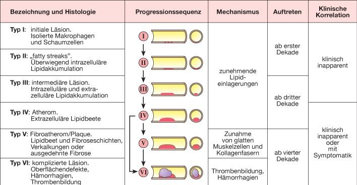 In der Intima sammeln sich in weiterer Folge extrazelluläre Fetttröpfchen an, welche anfangs noch zerstreut ( Präatherom oder Typ III Läsion) und später in größeren Gruppen zusammengefasst ( Atherom