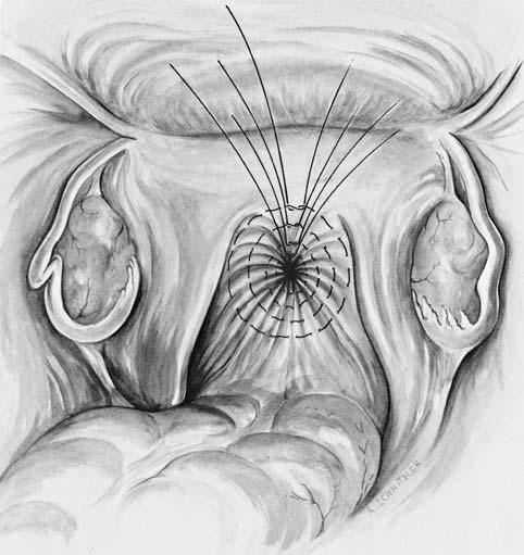 Review 1101 McCallʼs posterior culdoplasty Three internal sutures are placed from one uterosacral ligament to the other, and the cul-de-sac peritoneum is included several times in between.
