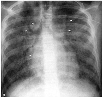 Lungenparenchym Erkrankungen Luftbronchogramm = alveoläres Infiltrat