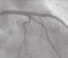 Durch den in das Herz kranzgefäß eingebrachten Herzkatheter wird ein fadenförmiger, sehr dünner weicher Draht in das Herzkranzgefäß wieder offen Herzkranzgefäß auch nach