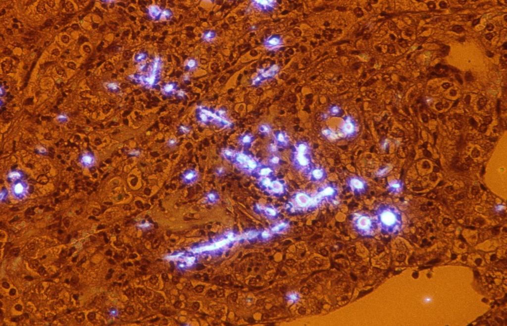 Fluoreszenz-Mikroskopie: Mykosen Kombinierte Färbung Mykoval