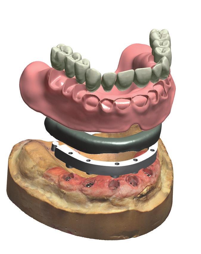 Geschäftswachstum durch digitale Erstellung implantatgetragener Restaurationen 3Shape Dental System bietet Zahntechnikern das vollständige Spektrum von Designoptionen und Behandlungsworkflows von den