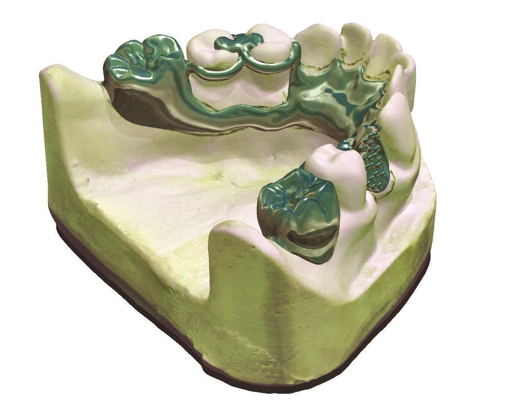 Digital modellierte Totalprothesen Die neueste Version der 3Shape Denture Design-Software zusammen mit neuen Fertigungsmöglichkeiten machen die digitale Fertigung von Prothesen für Labore überaus