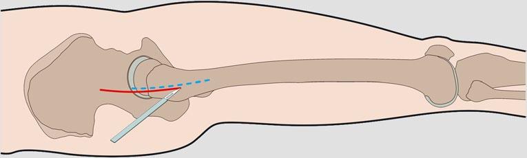 Abb. 6 8 Inzisionslinien für den minimalinvasiven (rote Linie, intramedulläre Implantate) und den klassischen lateralen Zugang (blaue Linie, extramedulläre Implantate und/oder offene