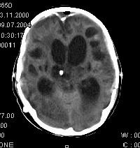 verzögerungstraumen kann zu prolongierter Bewußtlosigkeit ohne Beteiligung des Hirnstamms führen CT-Morphologie: stippchenförmige Blutungen Contusio: Strukturschädigung Aufblühen nach