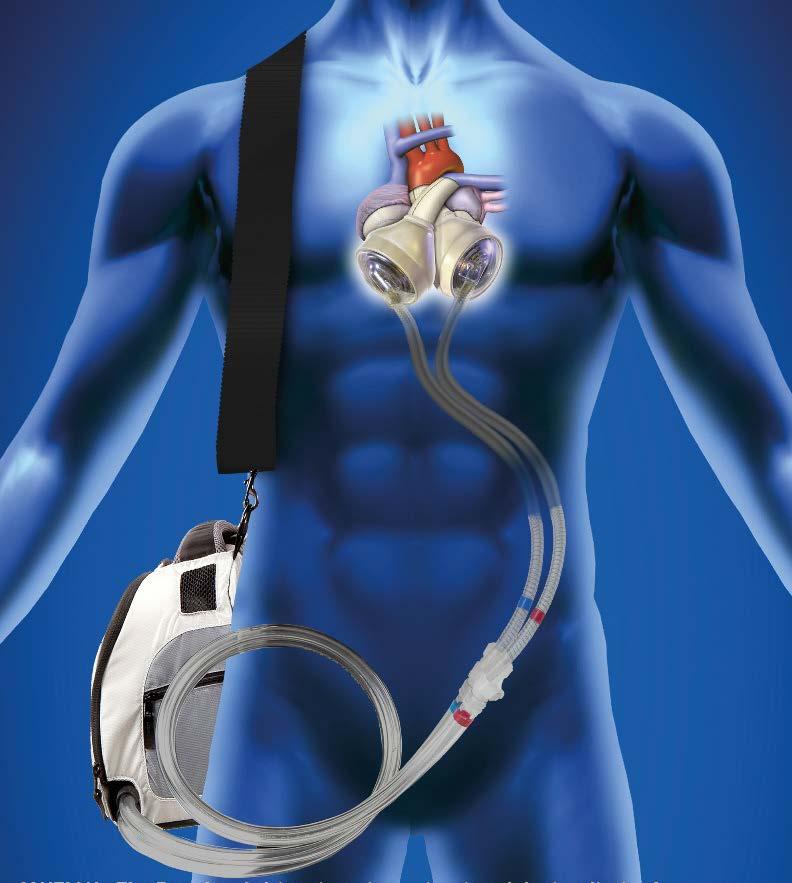 Künstliche Herzen Systeme: Kunstherz (Total Artificial Heart) Wenn eine Erholung der Pumpleistung des Herzen sicher ausgeschlossen ist. Das kranke Herz wird vollständig entfernt.