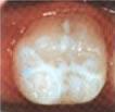 Zahnversiegelungen Bei Kindern und Jugendlichen entsteht die Karies häufig in den Furchen der Kauflächen, den Fissuren.