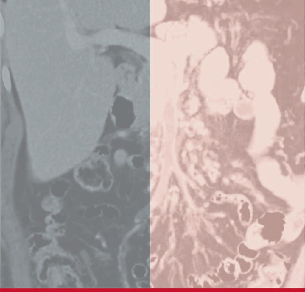 Zystische Pankreastumoren: Klassifikation und malignes Potenzial Esposito I, Schlitter AM Klöppel G Journal für Gastroenterologische und Hepatologische Erkrankungen