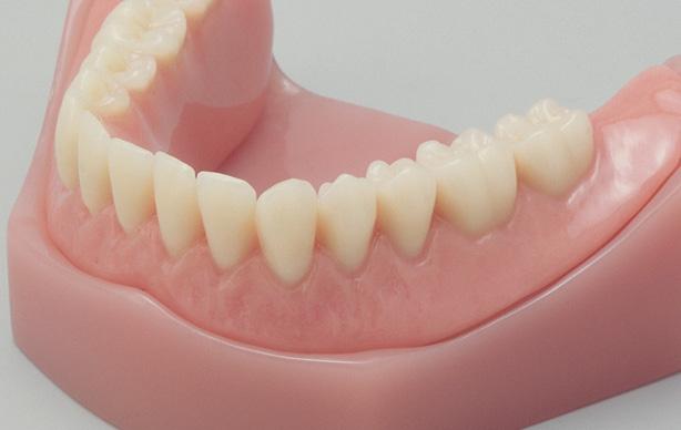 3 An den entsprechenden Stellen wird die bestehende Prothese des Patienten grosszügig ausgeschliffen und anschliessend im Mund