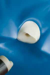 Mischung in reichlicher Menge auf Zahnhartsubstanz (Schmelz und