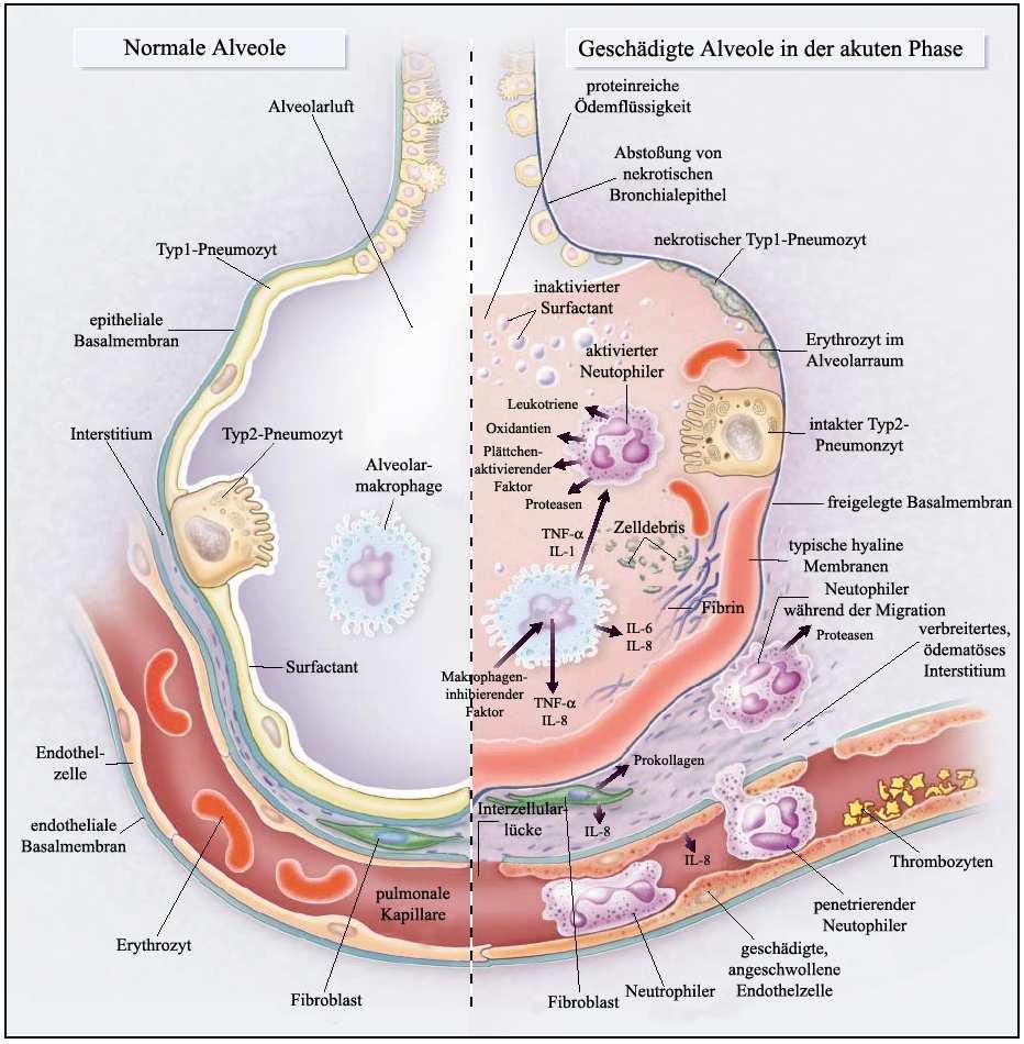 Abbildung 1: normale Alveole (links) und geschädigte Alveole während der akuten Phase des ARDS nach Ware [9]. 1.3.