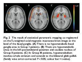 , Neuroimage 26, 912-921, 2005 Aus: Lyo et al., Brain 131, 438-446, 2008 a) Eckert et al.
