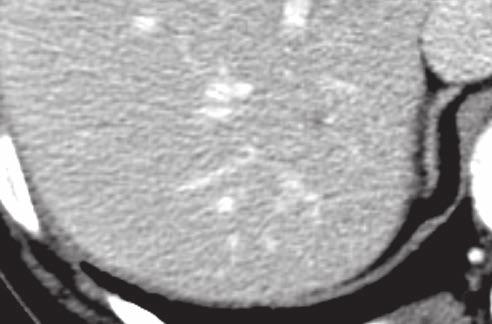 Eine weitere äsion konnte nicht Phase erschien die in der CT detektierte äsion als ein scharf detektiert werden (2). umrissener Bereich in der hepato biliären Phase (3, roter Pfeil).