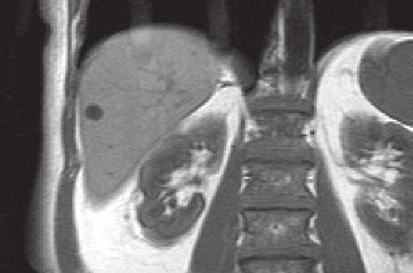 3 Bedeutung der Primovist -MRT für und Behandlung Bei einem Patienten mit bekanntem Adenokarzinom zeigte sich im CT-Scan eine klar umrissene, runde, homogene und hypodense äsion ohne
