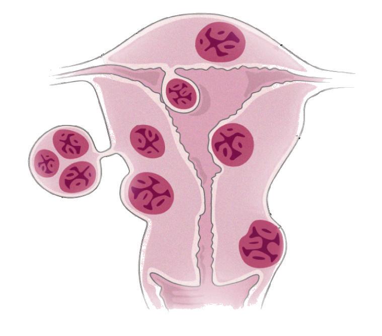 Welche Arten von Myomen gibt es? Welche Arten von Myomen gibt es? Intramurale Myome liegen innerhalb der Gebärmutterwand und sind die am häufigsten vorkommenden Myome.