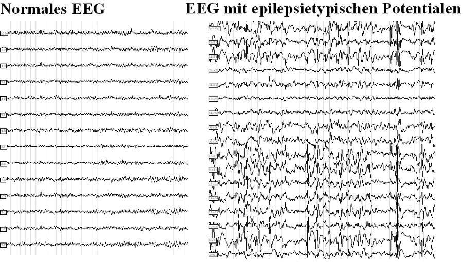 Elektroenzephalogramm (EEG) Bei Epilepsie