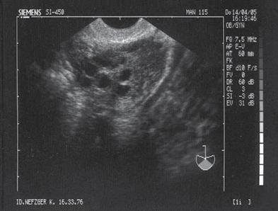 Werden in einem Eierstock mindestens 12 Follikel (2 9 mm) und/oder ein vergrößertes Ovar (Volumen 10 ml), fest gestellt, so ist ein diagnostisches Kriterium für polyzystische Ovarien erfüllt.