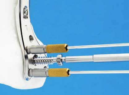 Operationstechnik Führungsbüchse entfernen und Schraube geeigneter Länge mit dem Schraubenzieher über den Führungsdraht in den Knochen einbringen.