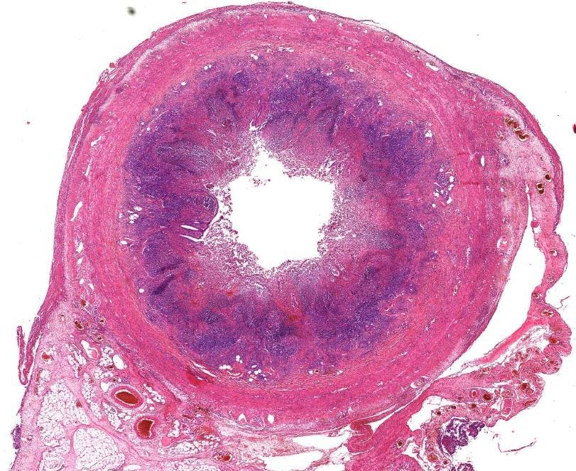 Appendix Ulzerophlegmonöse Appendizitis Schleimhautulcus und fibrinöseitriges Exsudat im Lumen Transmurales