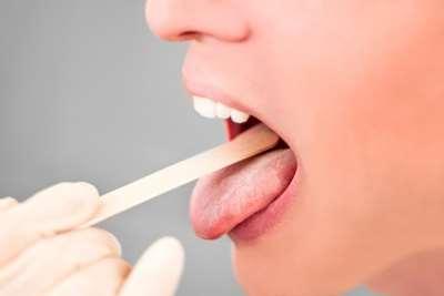 2. Rachenabstrich Zunge mit Spatel herunterdrücken oder mit Papierhandtuch greifen und nach vorne ziehen Tupfer einführen ohne dabei Lippen und Mundschleimhaut zu berühren Tupfer unter Druck von oben