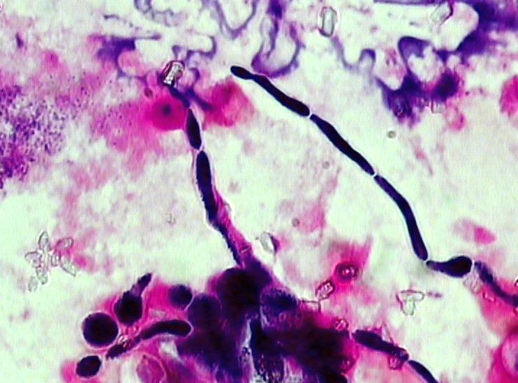 Seite 7 Diagnostik invasiver Candida-Infektionen. Mikroskopie Die direkte Mikroskopie des Probenmaterials stellt eine einfache, günstige und schnelle Möglichkeit zur Diagnose invasiver Mykosen dar.