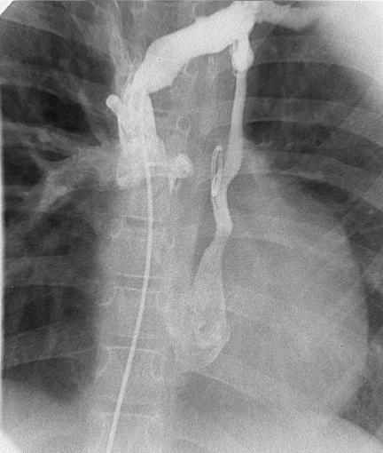 5 Ergebnisse 57 Bei einem Patienten der Gruppe B konnte bei der postoperativen Angiographie 1,9 Jahre nach der Kreislauftrennung eine reaperte linke Vena cava superior