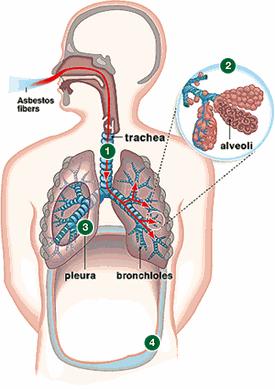 Aufnahme über Atemwege Asbest-Fasern gelangen bis in die Lungenbläschen Sie