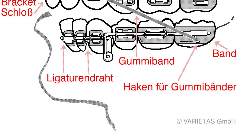 Zahnspange Nahe dem Glechgewcht 80