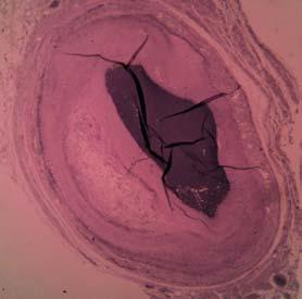 einem nekrotischen Lipidkern im Zentrum der Bsp. 1: Herz 42; Segment 3; Bild 316 KM Plaque hin. Abbildung 27 zeigt dies anhand von zwei Beispielen.