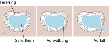 Zeichnungen: Hella Maren Thun, Grafik-Designerin Die Bandscheibe besteht aus zwei Anteilen: einem äußeren knorpeligen Faserring und einem inneren Gallertkern.