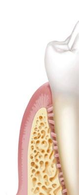 In vielen Fällen kann durch den Einsatz von Implantaten auf herausnehmbaren Zahnersatz (z.b. Pro thesen) verzichtet werden.