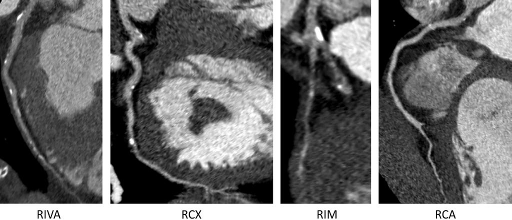 Advanced AV-Block in a Triathlete Fallbericht Abbildung 2 Das Kardio-CT des Patienten ergab keinen Hinweis auf eine flussrelevante koronare Herzerkrankung bei Arteriosklerose der Koronararterien mit