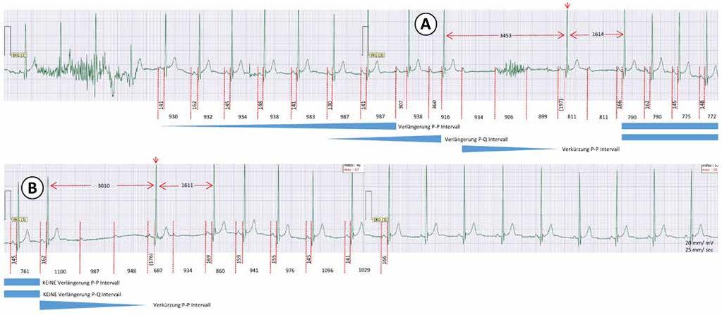 Fallbericht Höhergradige AV-Blockierungen bei Triathleten Abbildung 4 Fortlaufender Ausschnitt (circa 40 Sekunden, Zeitpunkt: 9:10 Uhr, Patient wach) aus dem Langzeit-EKG.