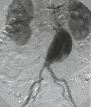 Subtraktionsangiografie (DSA) ohne Beteiligung der Nieren- und Beckenarterien. Im Bereich der Wand des Aneurysma sind thrombotische Ablagerungen sichtbar (Reiser, M. et al.