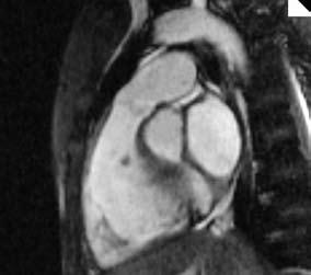 Oesophagus b Aorta ascendens Aortenbogen Truncus pulmonalis a RV LA Aortenklappe Infundibulum des RVOT Truncus pulmonalis