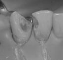 Aufgabe der Helferin: Trockenlegung zur Vermeidung der Speichelkontamination des geätzten Dentins (offene