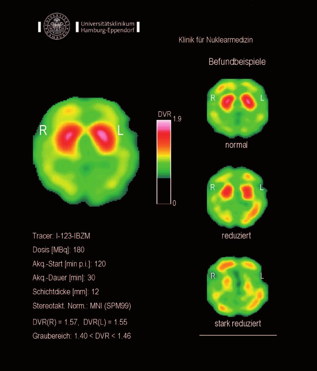 12 PARKINSON-SYNDROM 13 Differenzierung zwischen atypischen Parkinson Syndromen und Morbus Parkinson mit IBZM Was ist das Ziel der Untersuchung?