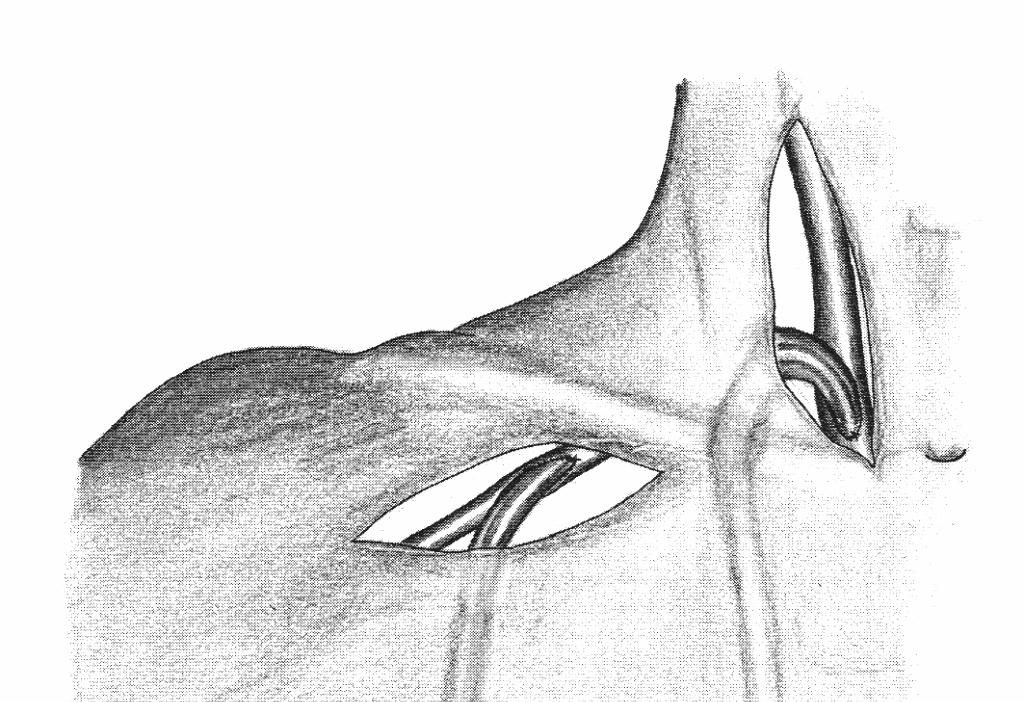 Zentrale AV-Shunts sind Anschlüsse an den subclavialen, jugularen, iliacalen oder femoralen Gefäßen.