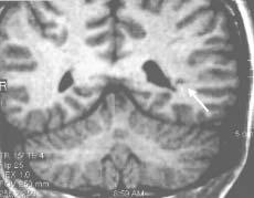 qui pourraient bénéficier d une lobectomie temporale et jusqu à 60% des lésions frontales de ceux qui pourraient bénéficier d une chirurgie du lobe frontal [2,3].