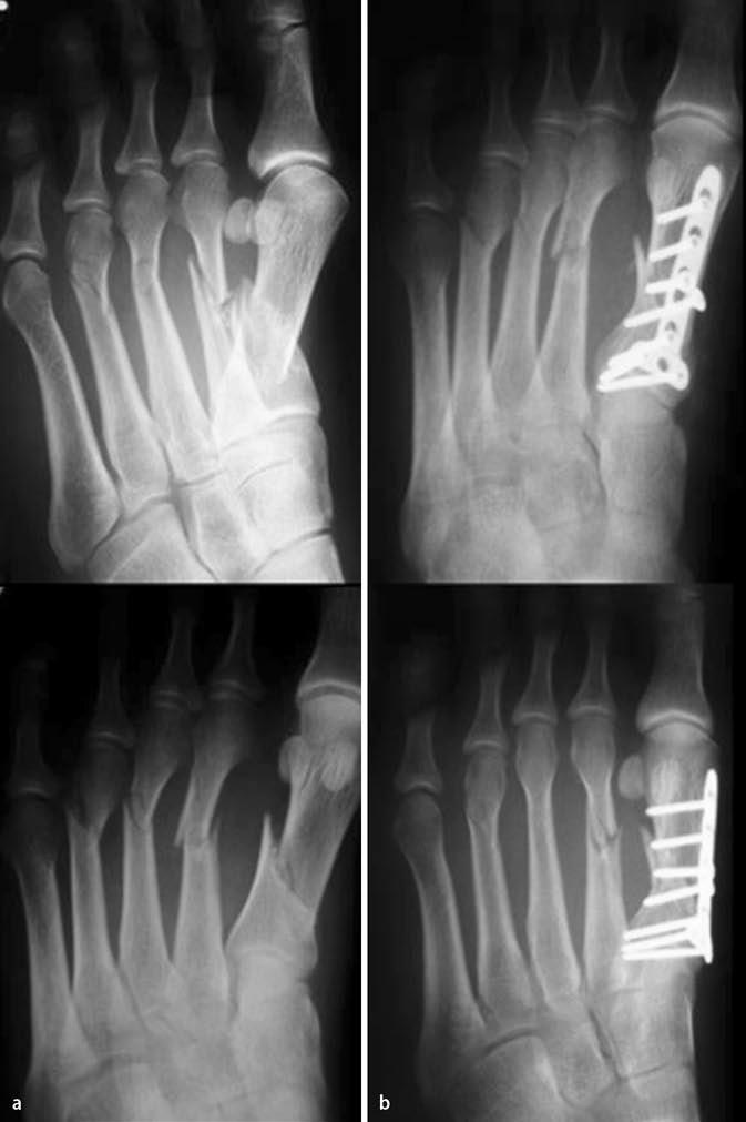 Der vermeintlich einfache Fall begleitenden Weichteilverletzungen. Bei Frakturnachweis im Bereich der Fußwurzel sind ein präoperatives CT und/oder ein intraoperatives Iso-C-3D zu empfehlen.