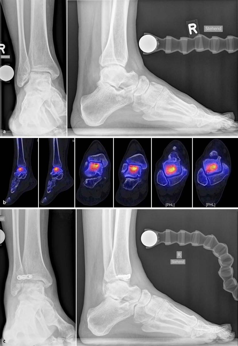 Leitthema Abb. 15 9 Anteriore distale Tibiaosteotomie. a Konventionelle Röntgenaufnahmen im Stehen einer 40-jährigen Patientin mit einer zentralen osteochondralen Läsion der hinteren Talusoberfläche.