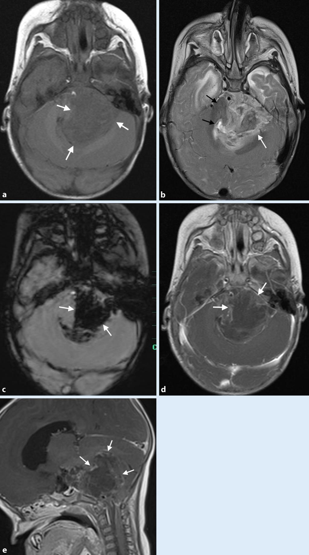 ternus ist beim Meningeom häufig nicht mitbetroffen, d. h. der Tumor wächst oft nicht in diesen vor. Intratumorale Verkalkungen sind bei Schwannomen selten und sprechen für ein Meningeom [3, 16, 17].