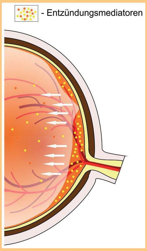 Abb. 6 Die Rolle des Glaskörpers in der Entstehung des zystoiden Makulaödems: anteriore vitreoretinale Traktion, partielle hintere Glaskörperabhebung, erhöhte Ausschüttung von Entzündungsmediatoren