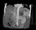 2007 Vorteile der Spiral-CT Kontinuierliche Akquisition in Atemstillstand Lebe