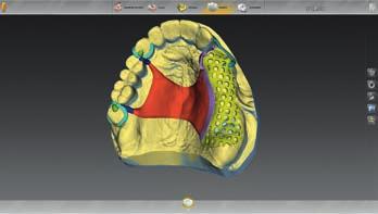 Bisssperrung eingescannt und anschließend an das Software Plugin inlab Splint übertragen.