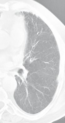 b Axiale CT auf Höhe des Truncus pulmonalis: plankonvexer, 5 mm großer Rundherd (Pfeil) am großen Lappenspalt (durch schwarzen Strich gekennzeichnet).