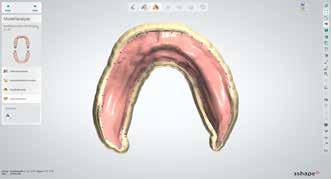 Digital Denture Professional Prothesenausdehnung Für die Prothesenausdehnung wird eine Markierung 1
